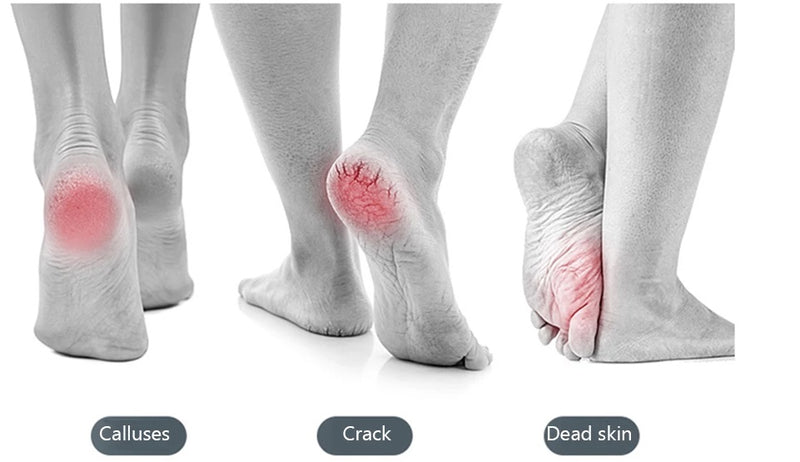 Electric Foot Skin Care Exfoliating Callus Remover Device Foot Grater Care Pedi Rechargeable